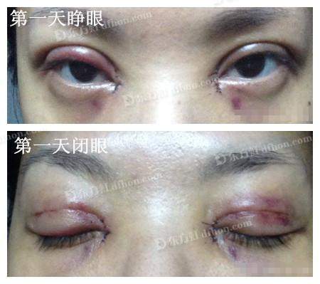 Cư dân mạng sốc nặng trước ảnh cắt mí hỏng của cô gái Việt 3