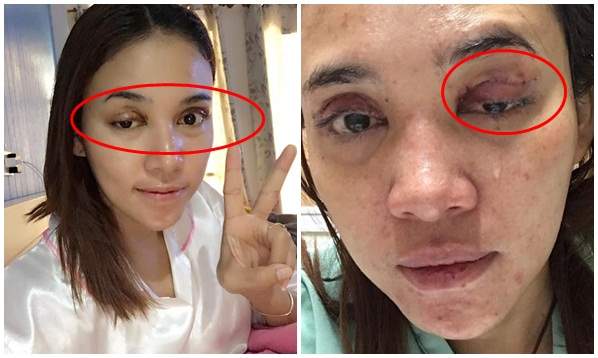 Cư dân mạng sốc nặng trước ảnh cắt mí hỏng của cô gái Việt 4