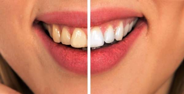 8 cách đơn giản đẩy lùi bệnh sâu răng một cách tự nhiên nhất 5