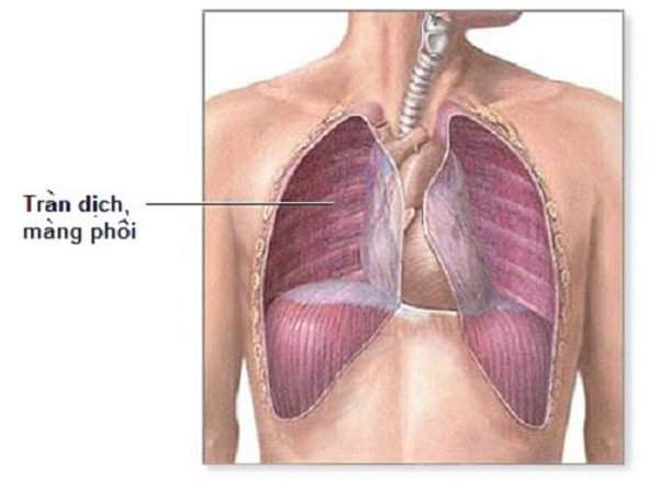 Dấu hiệu của tràn dịch màng phổi và cách điều trị 2