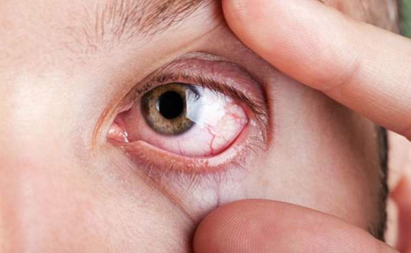 Bệnh khô mắt và những hiểm họa khó lường 2