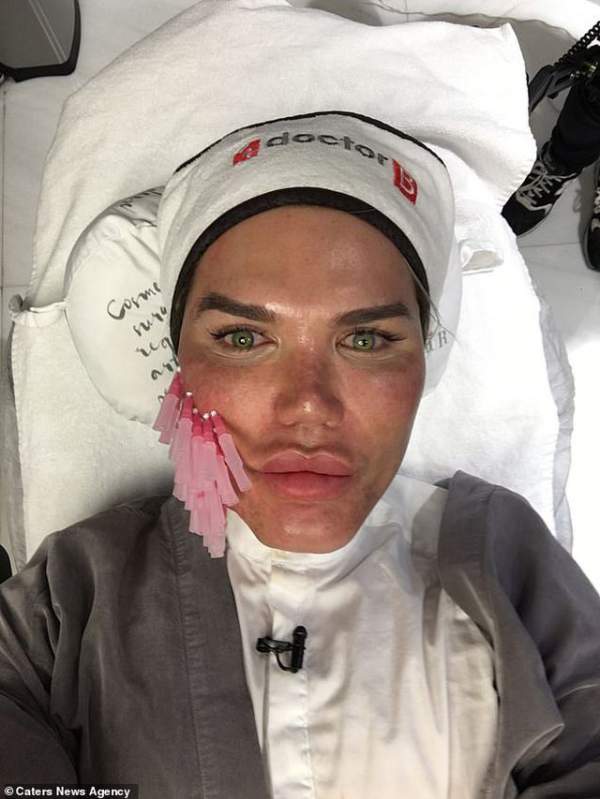 Gương mặt sưng phồng đáng sợ của Rodrigo Alves sau ca “dao kéo” 3
