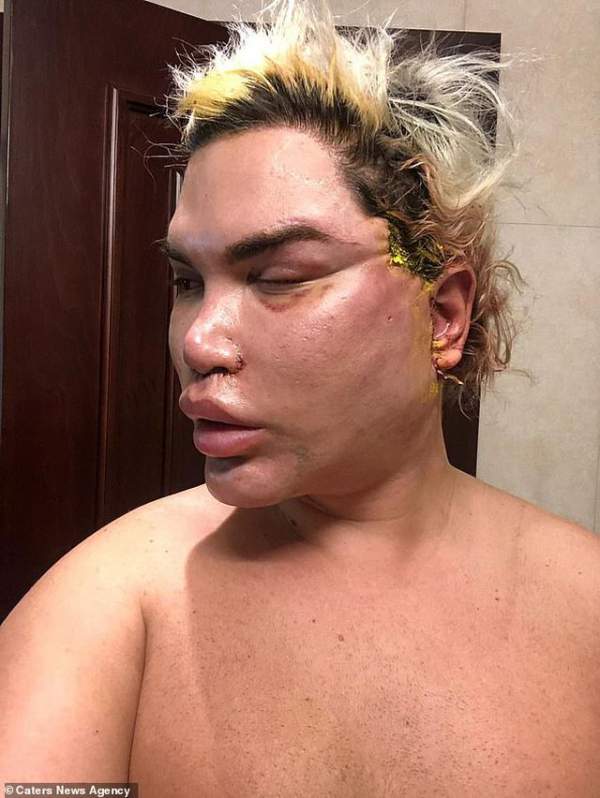 Gương mặt sưng phồng đáng sợ của Rodrigo Alves sau ca “dao kéo” 2