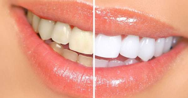 14 cách làm răng trắng hơn 2