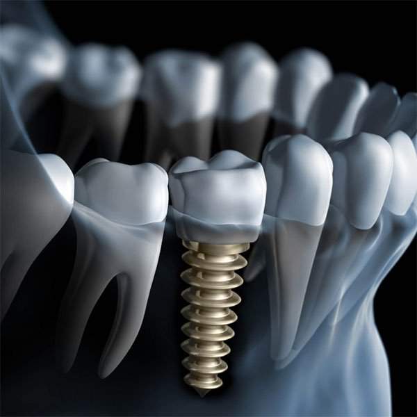 Cấy ghép răng implant là gì? 2