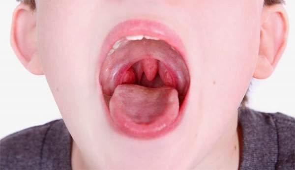 10 nguyên nhân khiến cổ họng có cảm giác bị vướng 3