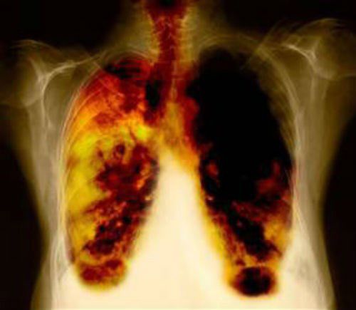 Hít khí than tổ ong, người phụ nữ có phổi đen xì