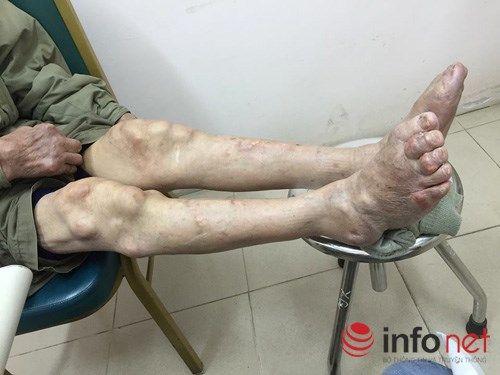 Suy thận vì điều trị gout ở phòng khám đông y Trung Quốc 3