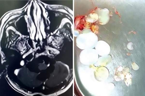 Buồn nôn đến viện khám, không ngờ phát hiện 30 trứng sán dây trong đầu