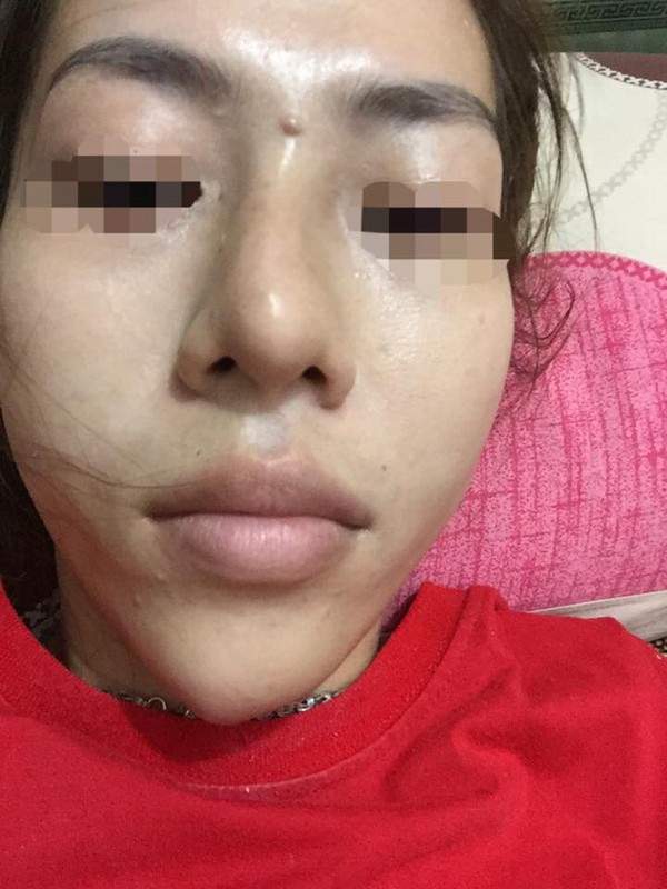 Dân mạng khiếp vía vụ cô gái Sài Gòn có mũi sưng đen vì tiêm chất làm đầy 6