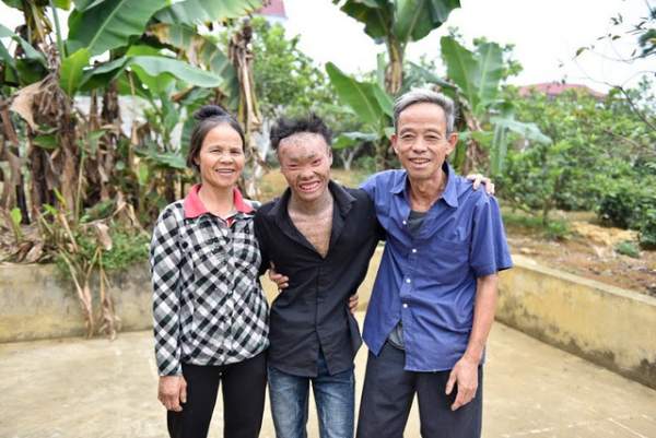Cuộc sống lạc quan của 9x mắc bệnh "người cá" hiếm gặp ở Hà Nội 14