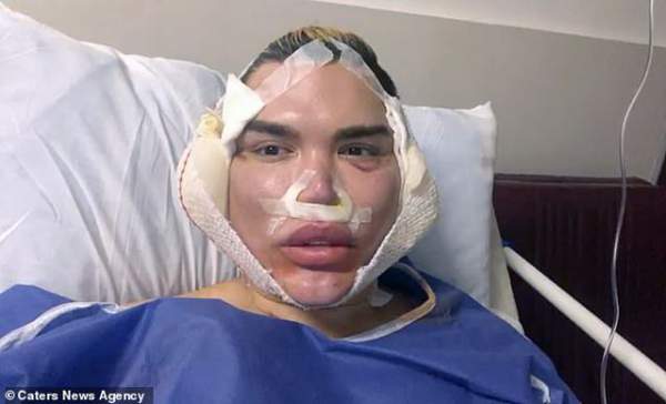 Gương mặt sưng phồng đáng sợ của Rodrigo Alves sau ca “dao kéo”