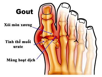 Bệnh Gout: Nguyên nhân, triệu chứng và cách điều trị 2