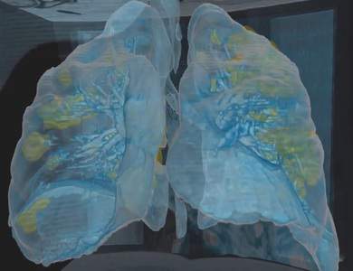 Video cho thấy phổi bị tổn thương nặng của bệnh nhân Covid-19