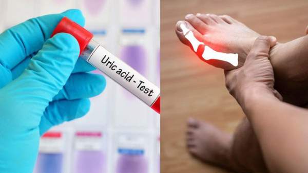 Top 10 cách "đào thải" acid uric một cách tự nhiên, ngừa gout hiệu quả: Nhiều người chưa biết để làm!